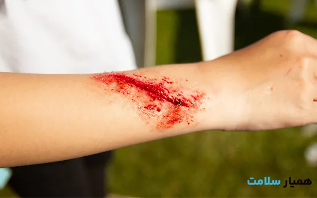 پانسمان زخم باز در کرج