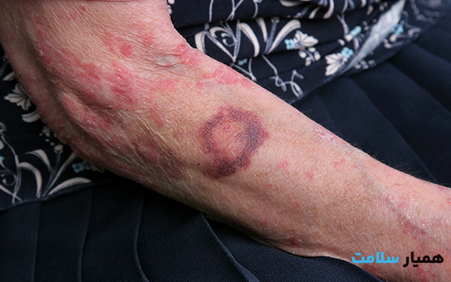 جلوگیری از زخم بستر در سالمندان