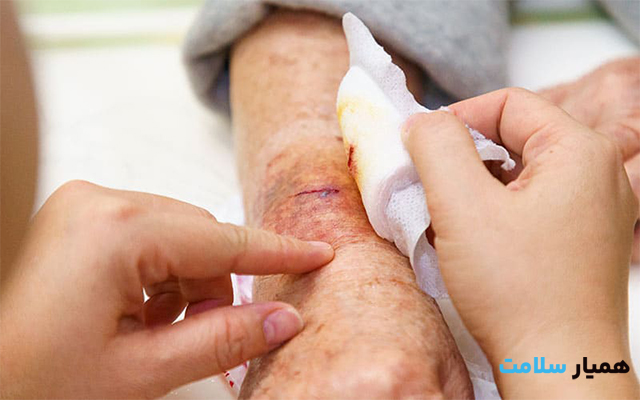 درمان زخم بستر در سالمندان